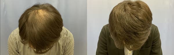 頭頂植髮個案一 (2000株) - 術前