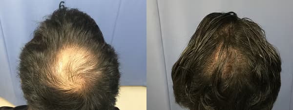 頭頂植髮個案二 (2000株) - 術前