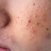 荷爾蒙失調導致脫髮