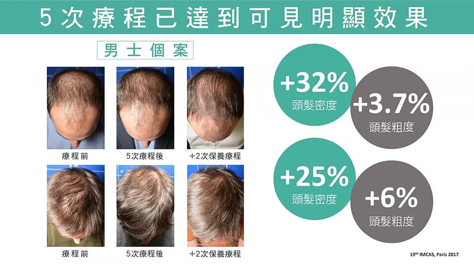 增髮注養滲透療程5次療程後效果對比
