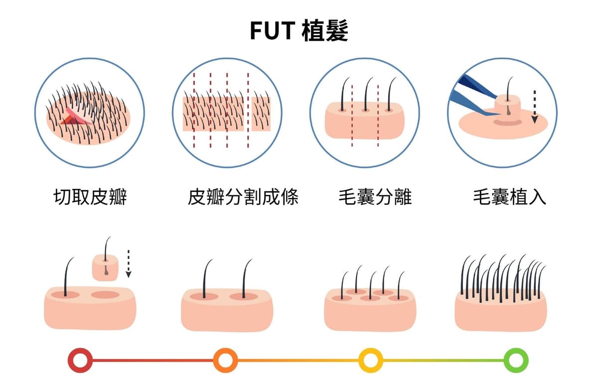 FUT 植髮技術步驟示意圖