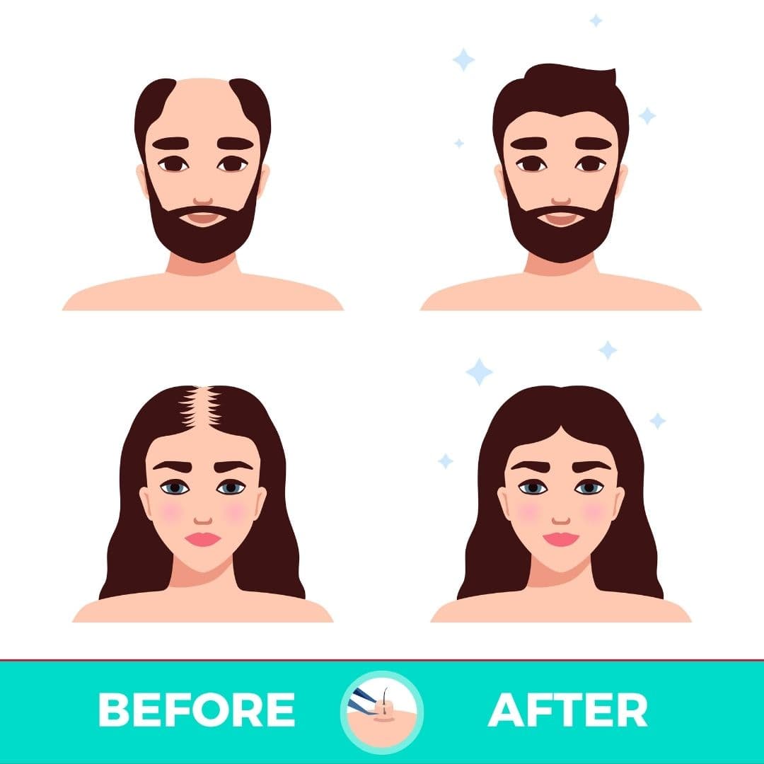 植髮適合度自我評估 — 男女植髮前後對比