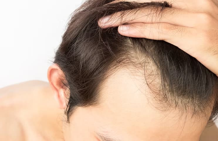 增髮注養滲透療程能根治各種脫髮問題