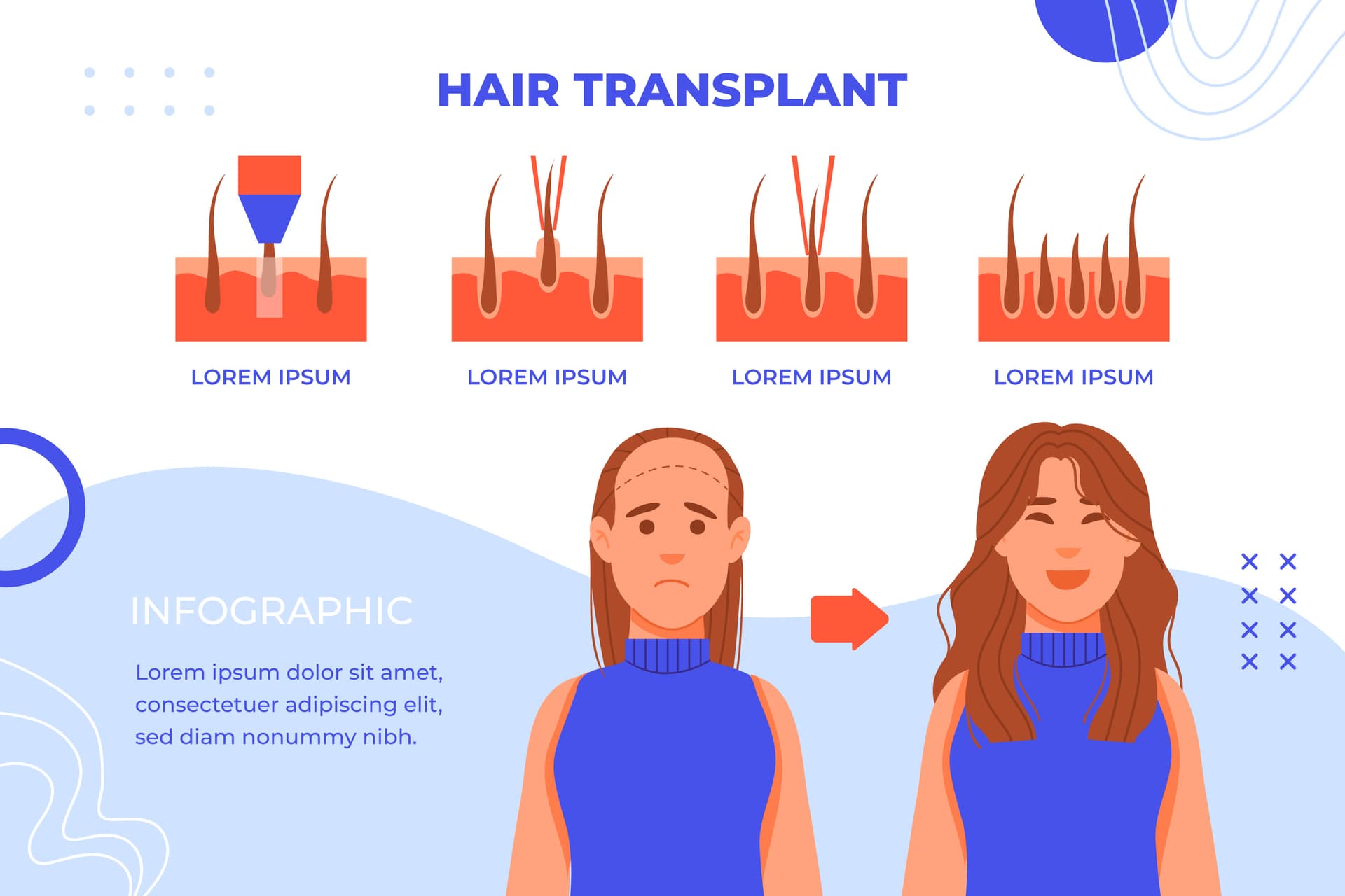 植髮過程示意圖 — Hair Transplant 從提取到植入的完整流程