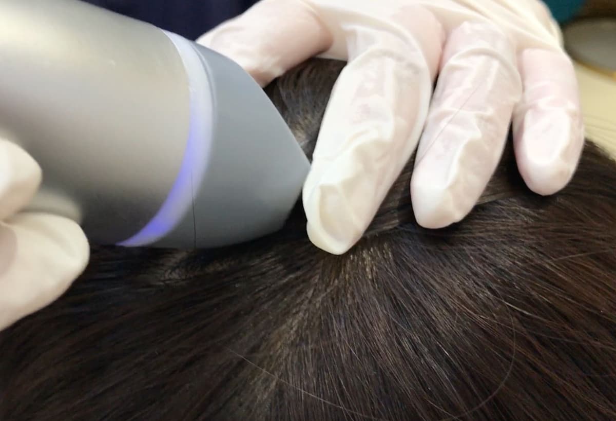 育髮療程 — 頭皮微環境改善